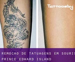 Remoção de tatuagens em Souris (Prince Edward Island)