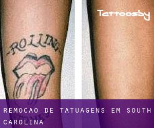 Remoção de tatuagens em South Carolina