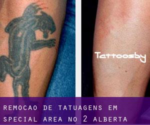 Remoção de tatuagens em Special Area No. 2 (Alberta)