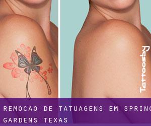 Remoção de tatuagens em Spring Gardens (Texas)