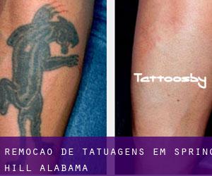Remoção de tatuagens em Spring Hill (Alabama)