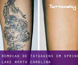 Remoção de tatuagens em Spring Lake (North Carolina)