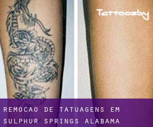 Remoção de tatuagens em Sulphur Springs (Alabama)
