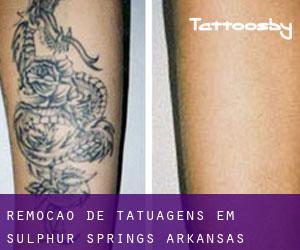 Remoção de tatuagens em Sulphur Springs (Arkansas)