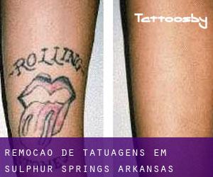 Remoção de tatuagens em Sulphur Springs (Arkansas)