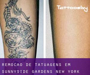 Remoção de tatuagens em Sunnyside Gardens (New York)