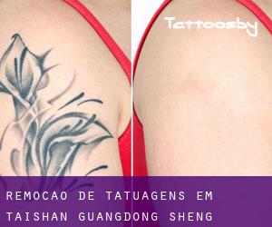 Remoção de tatuagens em Taishan (Guangdong Sheng)