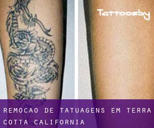 Remoção de tatuagens em Terra Cotta (California)