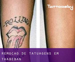 Remoção de tatuagens em Thabeban