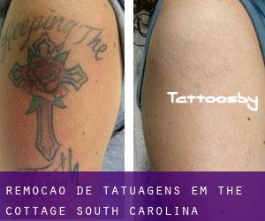 Remoção de tatuagens em The Cottage (South Carolina)