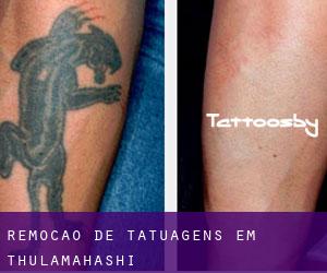 Remoção de tatuagens em Thulamahashi