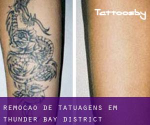 Remoção de tatuagens em Thunder Bay District