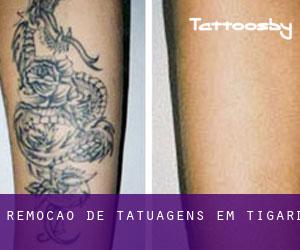 Remoção de tatuagens em Tigard