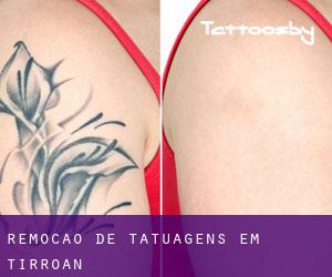 Remoção de tatuagens em Tirroan
