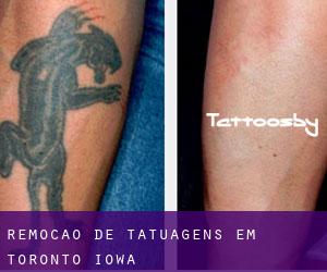Remoção de tatuagens em Toronto (Iowa)