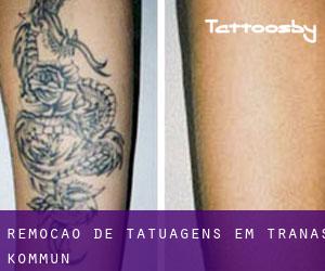 Remoção de tatuagens em Tranås Kommun