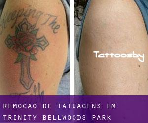 Remoção de tatuagens em Trinity Bellwoods Park