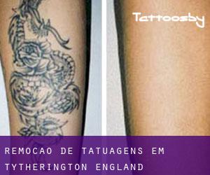 Remoção de tatuagens em Tytherington (England)