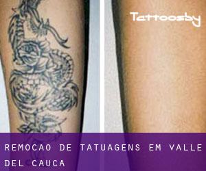 Remoção de tatuagens em Valle del Cauca
