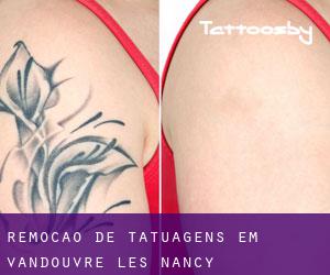 Remoção de tatuagens em Vandœuvre-lès-Nancy