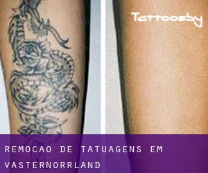 Remoção de tatuagens em Västernorrland