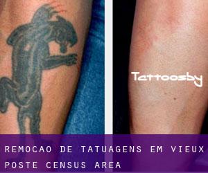 Remoção de tatuagens em Vieux-Poste (census area)
