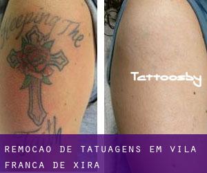 Remoção de tatuagens em Vila Franca de Xira