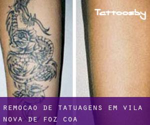 Remoção de tatuagens em Vila Nova de Foz Côa
