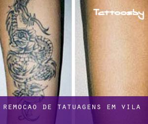 Remoção de tatuagens em Ávila