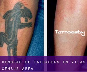 Remoção de tatuagens em Vilas (census area)