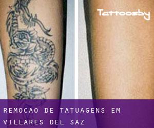 Remoção de tatuagens em Villares del Saz