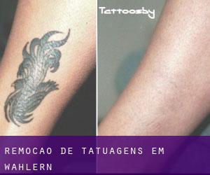 Remoção de tatuagens em Wahlern