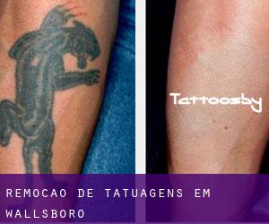 Remoção de tatuagens em Wallsboro