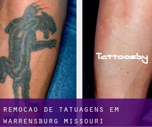 Remoção de tatuagens em Warrensburg (Missouri)