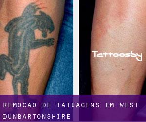 Remoção de tatuagens em West Dunbartonshire