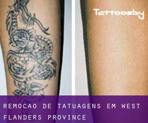 Remoção de tatuagens em West Flanders Province