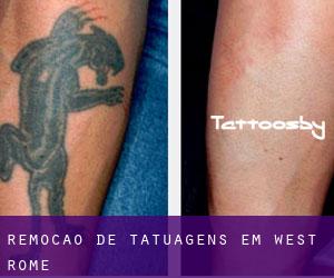 Remoção de tatuagens em West Rome