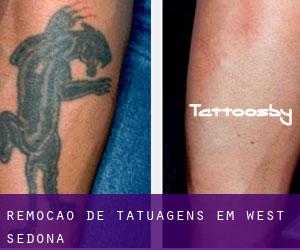 Remoção de tatuagens em West Sedona