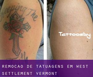 Remoção de tatuagens em West Settlement (Vermont)