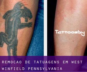 Remoção de tatuagens em West Winfield (Pennsylvania)