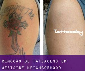 Remoção de tatuagens em Westside Neighborhood