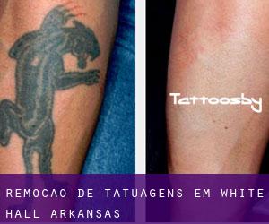 Remoção de tatuagens em White Hall (Arkansas)