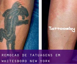 Remoção de tatuagens em Whitesboro (New York)