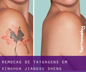 Remoção de tatuagens em Xinghua (Jiangsu Sheng)