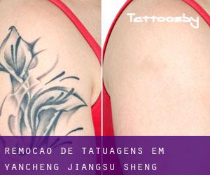 Remoção de tatuagens em Yancheng (Jiangsu Sheng)