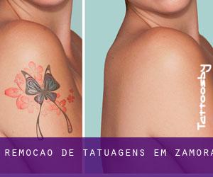 Remoção de tatuagens em Zamora
