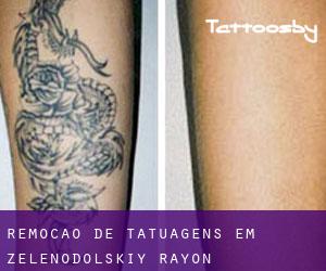 Remoção de tatuagens em Zelenodol'skiy Rayon